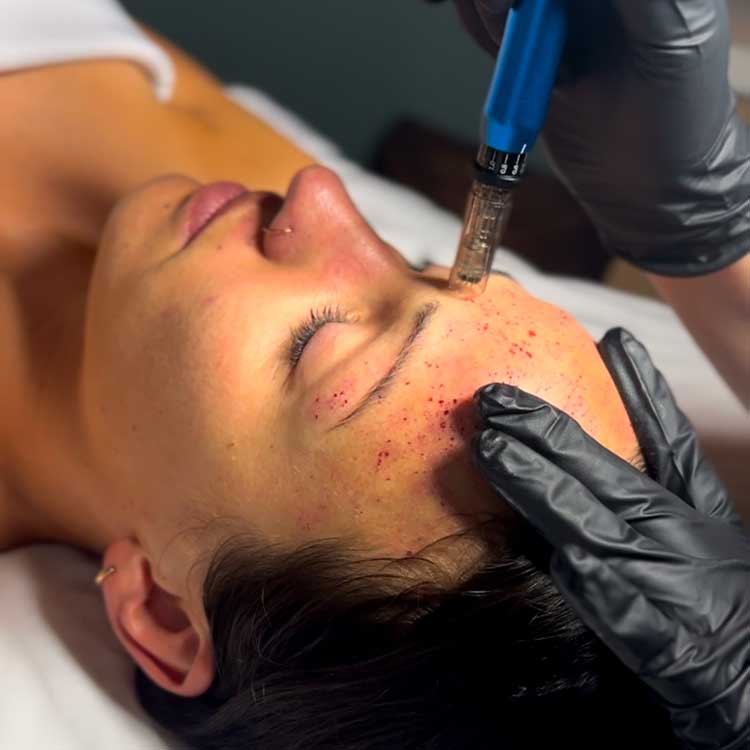 Microneedling